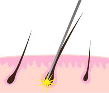 Needle delivers electric shock