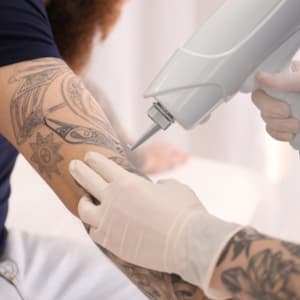 Tattoo Removal specialist removing a tattoo