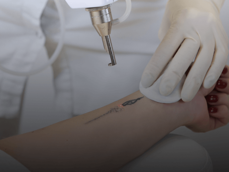 esthetician removing a tattoo